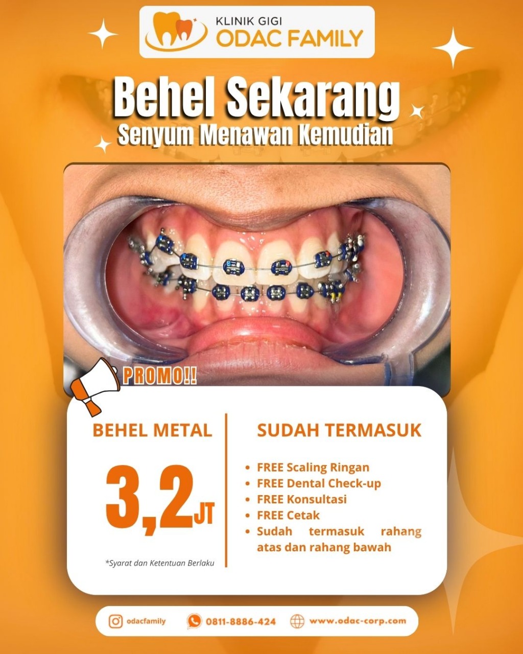 Bingung atau takut pasang behel? Yuk, intip sekilas proses pemasangan behel/ortho di ODAC Family!